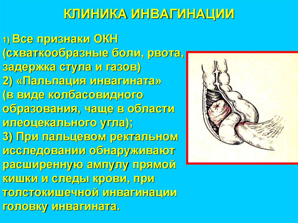 КЛИНИКА ИНВАГИНАЦИИ