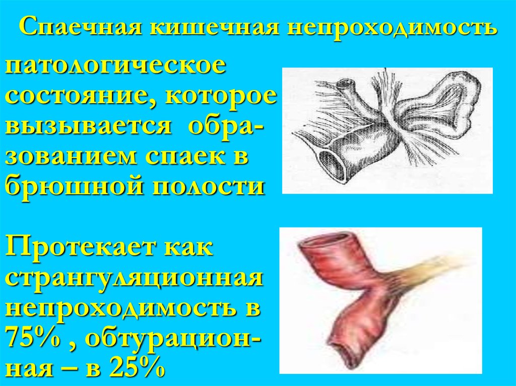 Спаечная кишечная непроходимость