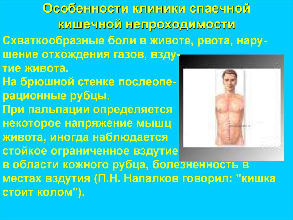 Особенности клиники спаечной кишечной непроходимости