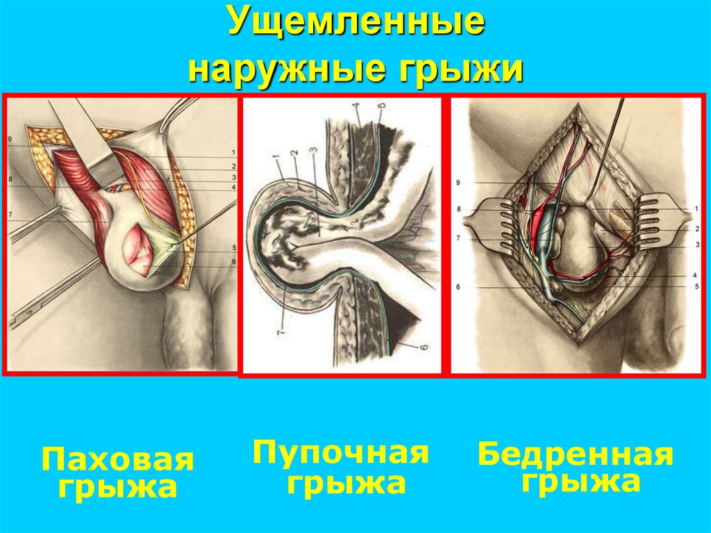 Ущемленные наружные грыжи
