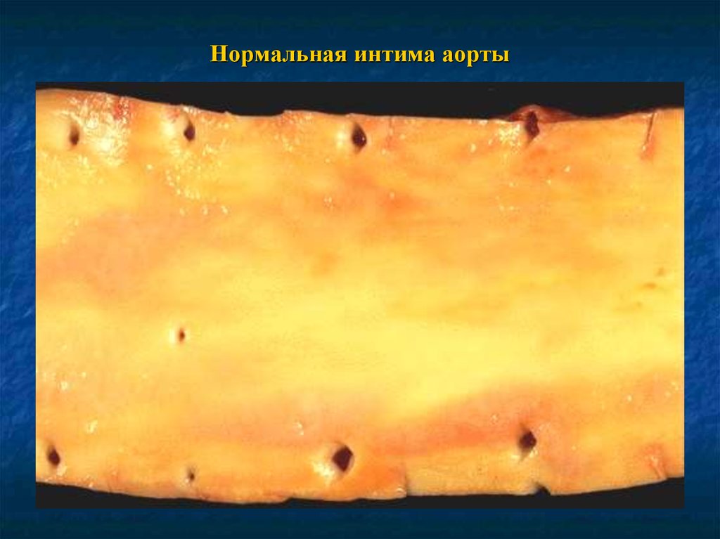 Нормальная интима аорты