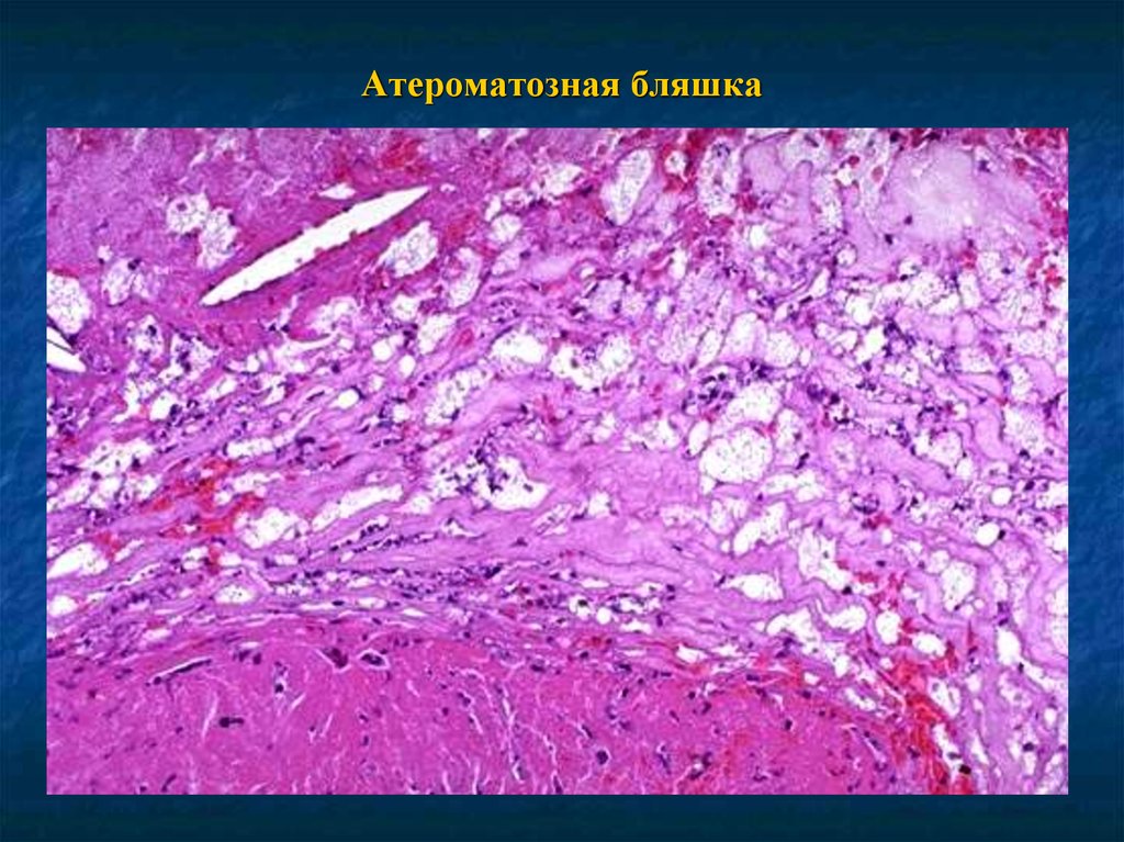 Атероматозная бляшка