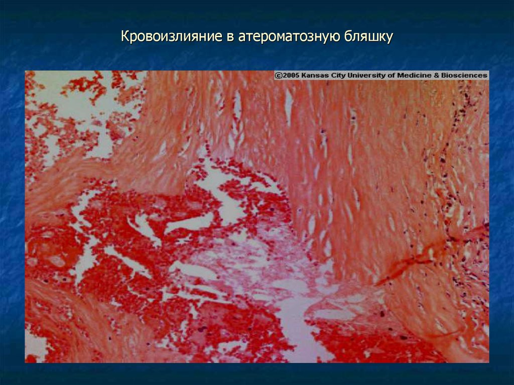 Кровоизлияние в атероматозную бляшку