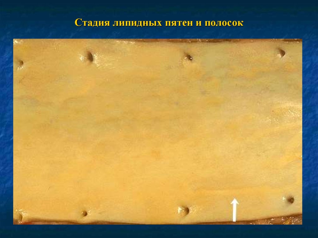 Стадия липидных пятен и полосок