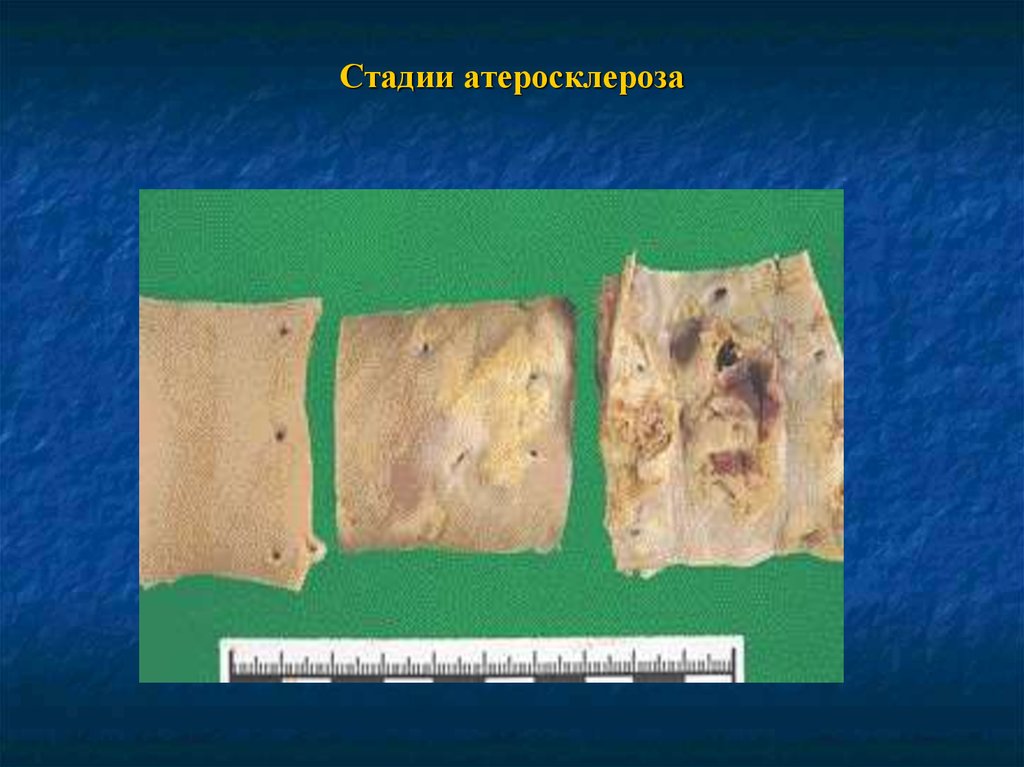 Атеросклероз аорты стадии. Атеросклероз аорты 1 степени. Клинические формы атеросклероза. Гипертоническая болезнь этиология и патогенез. Атеросклероз стадии и степени.