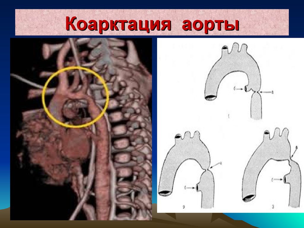 Коарктация аорты картинки