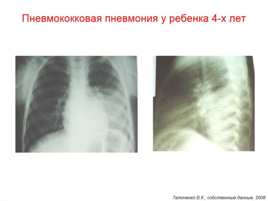 Пневмония у детей картинки для презентации - 82 фото