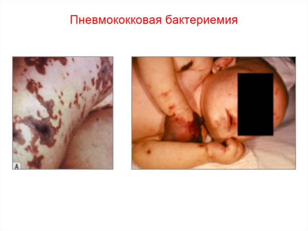 Пневмококковая бактериемия