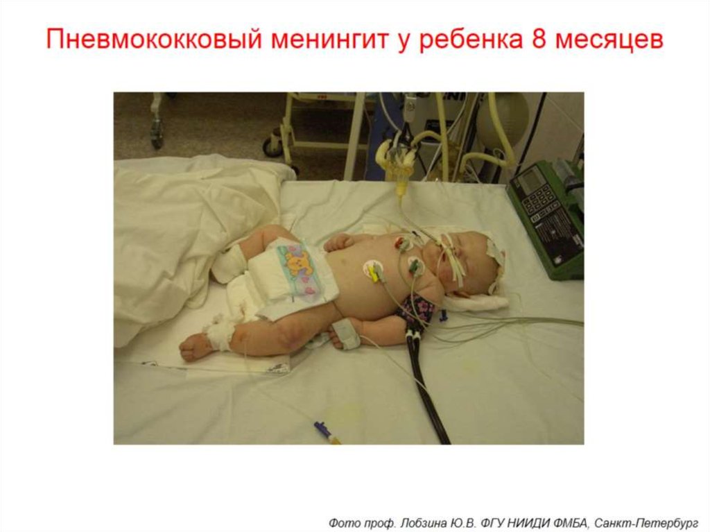 Пневмококковый менингит у ребенка 8 месяцев