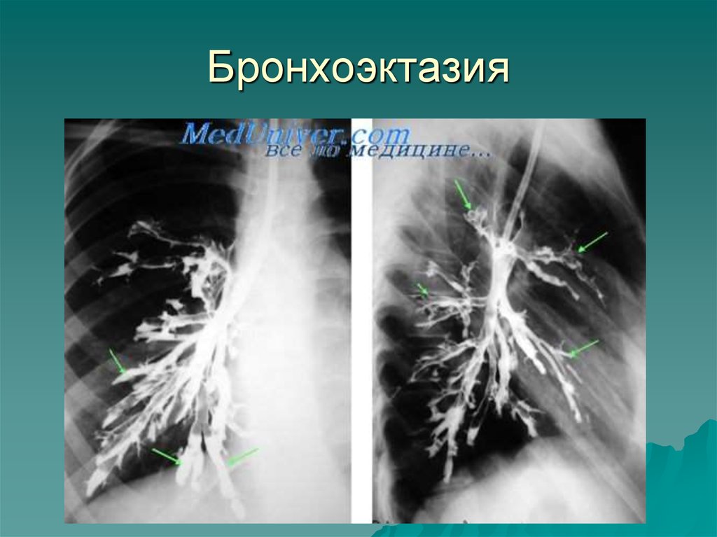 Бронхоэктатическая болезнь картинки