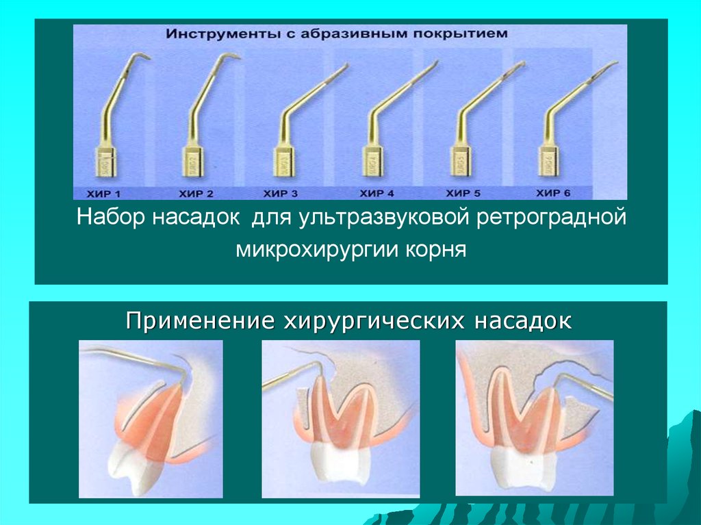 Эндодонтическая обработка корневого канала