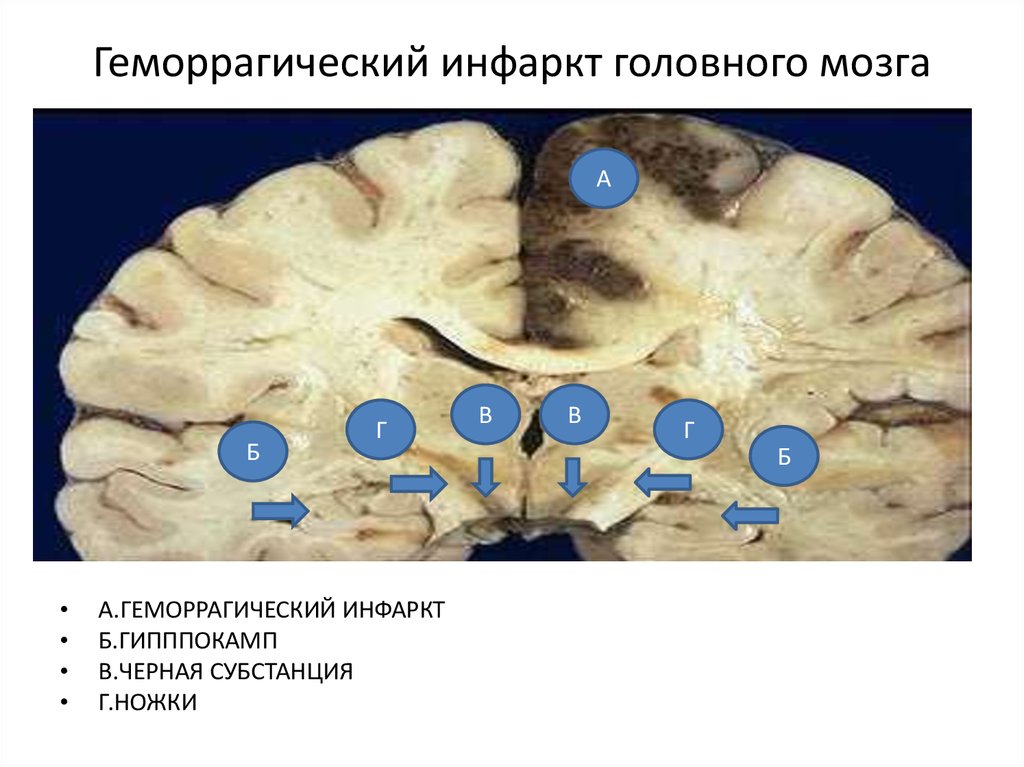 Инфаркт головного мозга фото