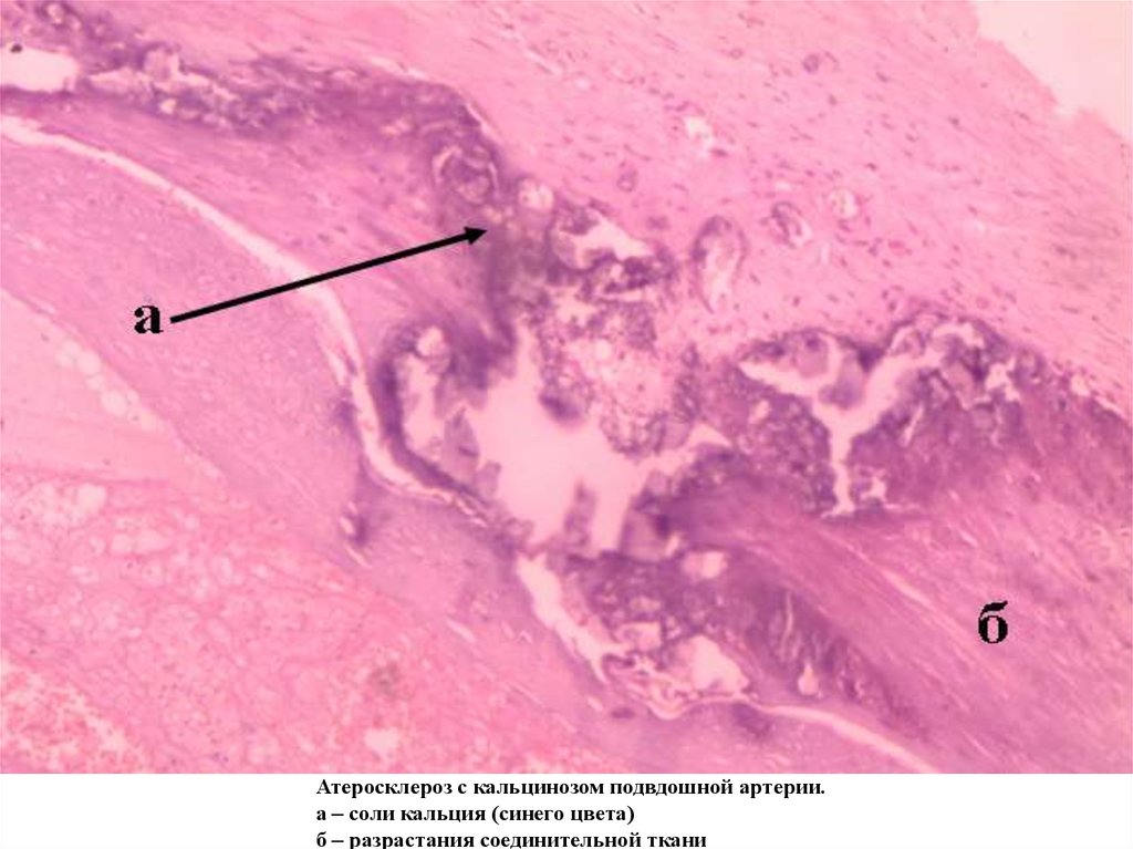 Атеросклероз патанатомия презентация