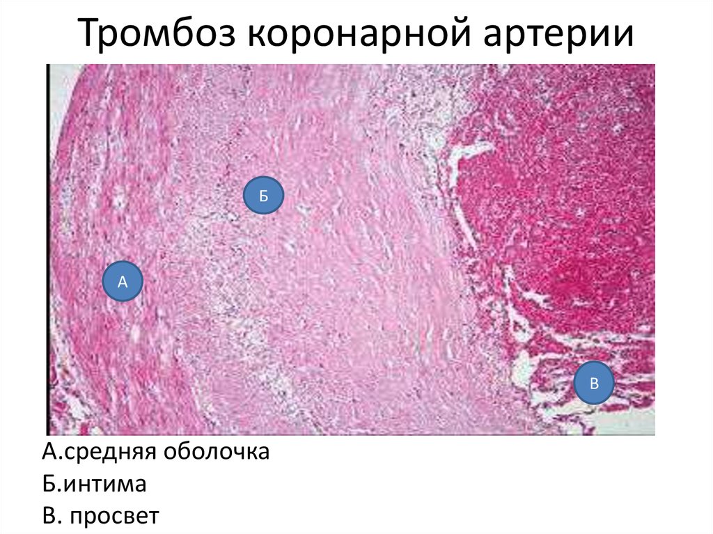 Тромбоз коронарных артерий