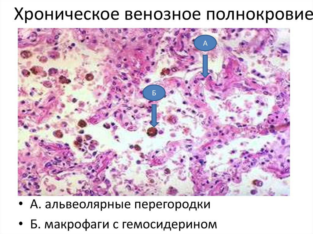 Ибс патологическая анатомия презентация