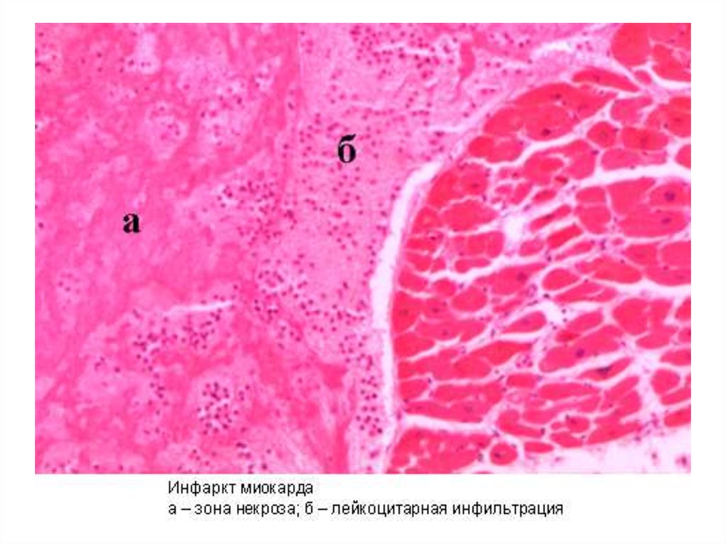 Инфаркт миокарда патологическая анатомия презентация