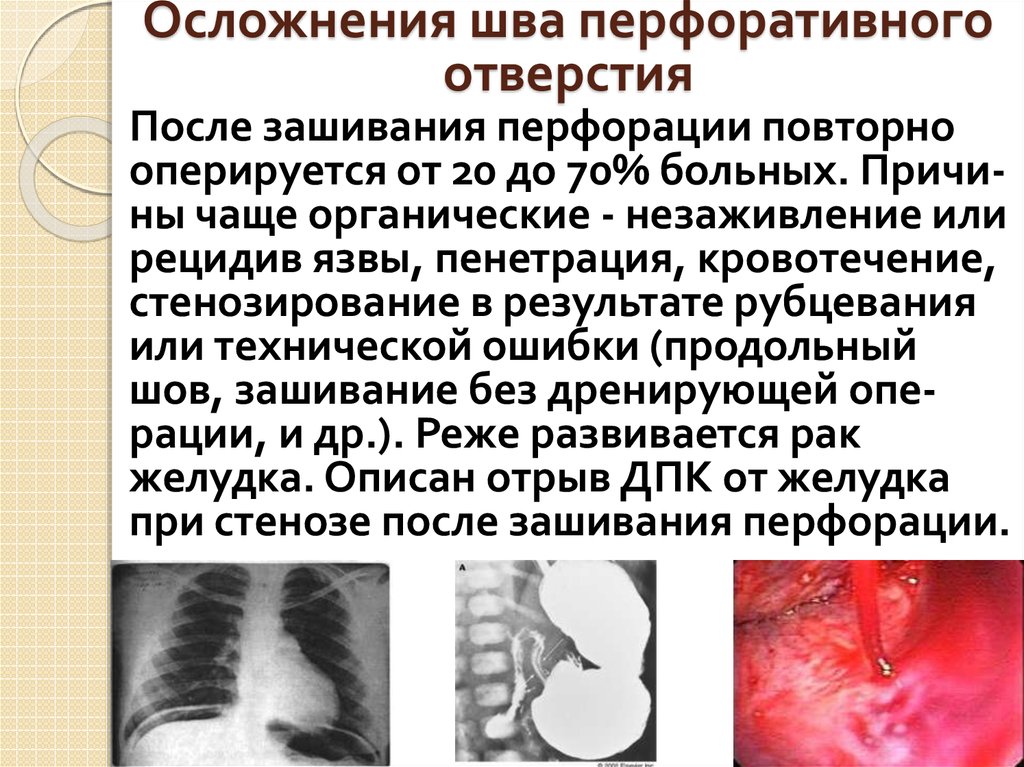 Осложнения шва перфоративного отверстия