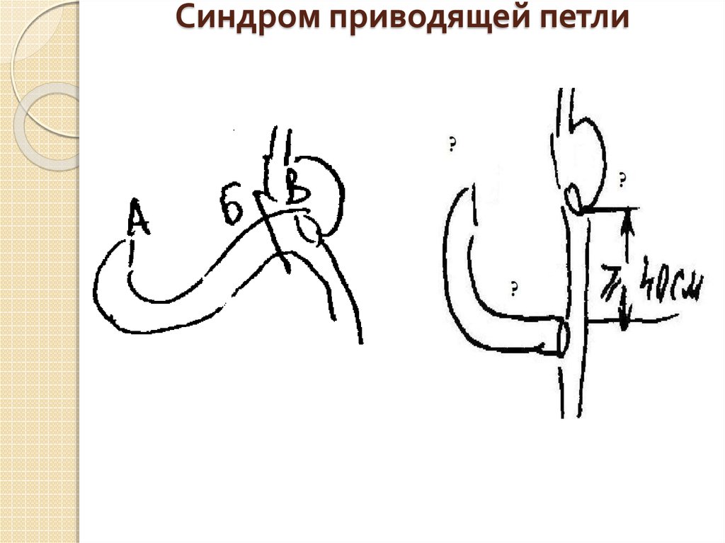 Операция тивити петля фото схема