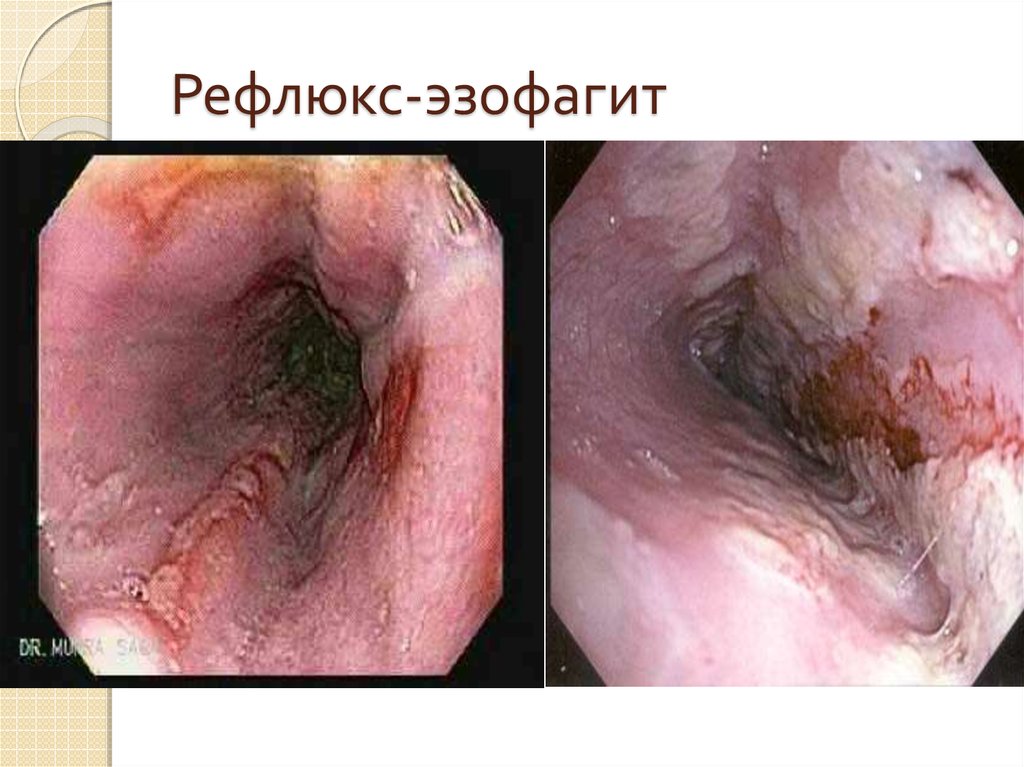 Рефлюкс-эзофагит