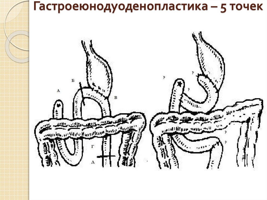 Гастроеюнодуоденопластика – 5 точек