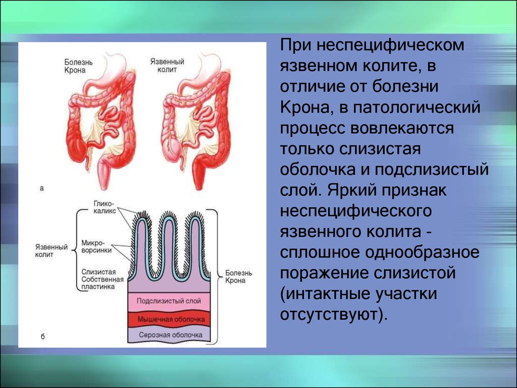 Клиническая картина хронического колита