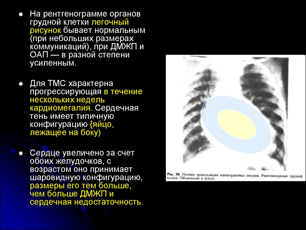 Легочный рисунок усилен за счет сосудистого компонента