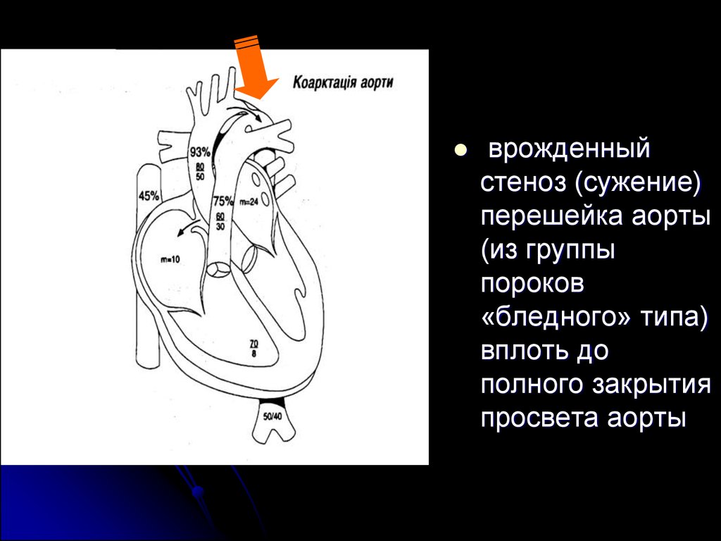 Тетрада фалло гемодинамика схема