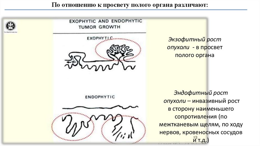 Эндофитный рост опухоли. Экзофитный и эндофитный рост это. Экзофитный и эндофитный рост опухоли. Экзофитная форма роста опухоли что это такое. Типы роста опухолей схема.