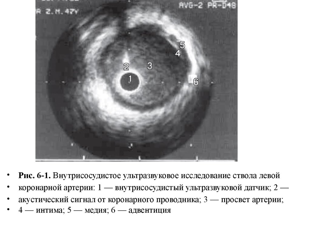 Узи коронарных артерий. Внутрикоронарное ультразвуковое исследование. ВСУЗИ коронарных артерий. Внутрисосудистое ультразвуковое исследование коронарных артерий. Внутрисосудистое УЗИ-исследование.