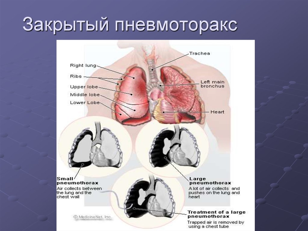 Пневмоторакс картинки для презентации