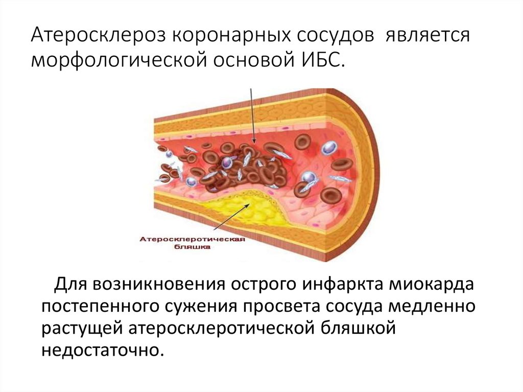 Схема тромбоза при атеросклерозе мозговых артерий