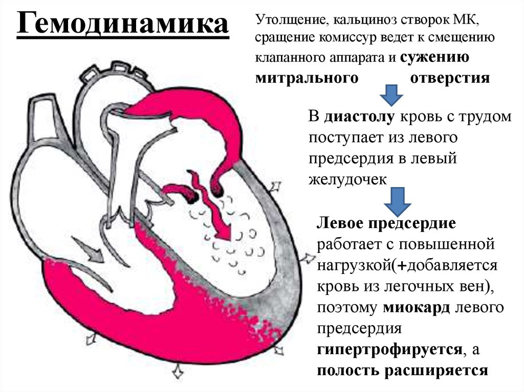 Гемодинамика при митральном стенозе