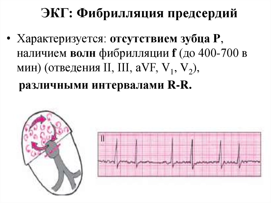 Фибрилляция предсердий на экг признаки фото