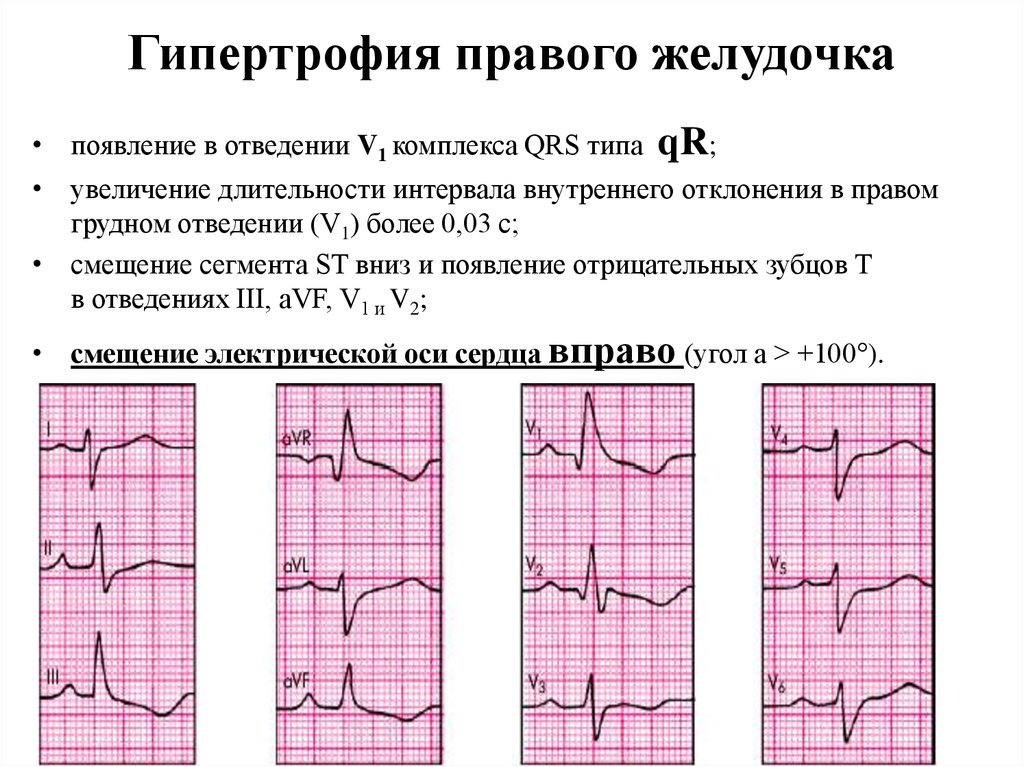 Перегрузка на экг что это. Признаки гипертрофии правого желудочка на ЭКГ. ЭКГ правый гипертрофия правый желудочек. Гипертрофия правого желудочка сердца на ЭКГ. ЭКГ гипертрофия правого желудочка ЭКГ.