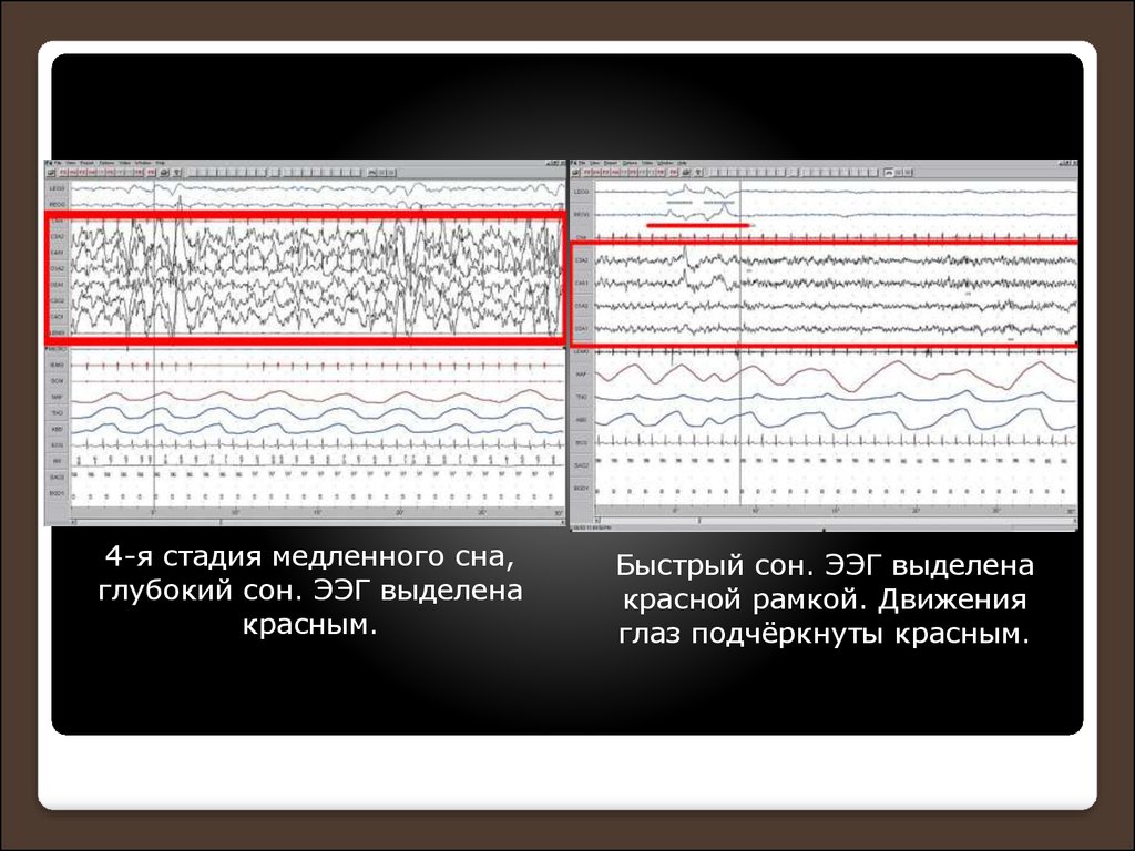 Ээг сна. Фаза быстрого сна ЭЭГ. Фазы медленного сна ЭЭГ. Электроэнцефалограмма медленного сна. Глубокий сон на ЭЭГ.