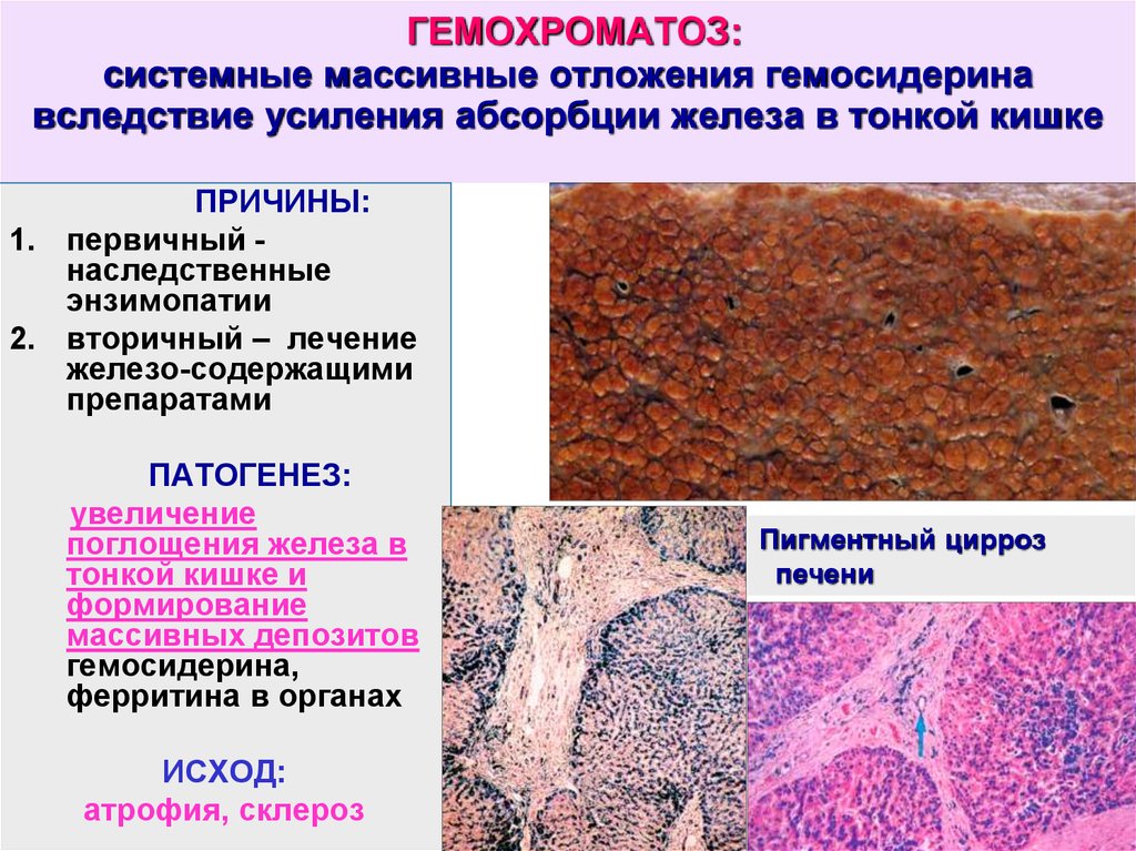 Железистые клетки печени. Основной клинический признак первичного гемохроматоза:. Гемохроматоз этиология патогенез. Печень при гемохроматозе макропрепарат. Гемохроматоз печени этиология.
