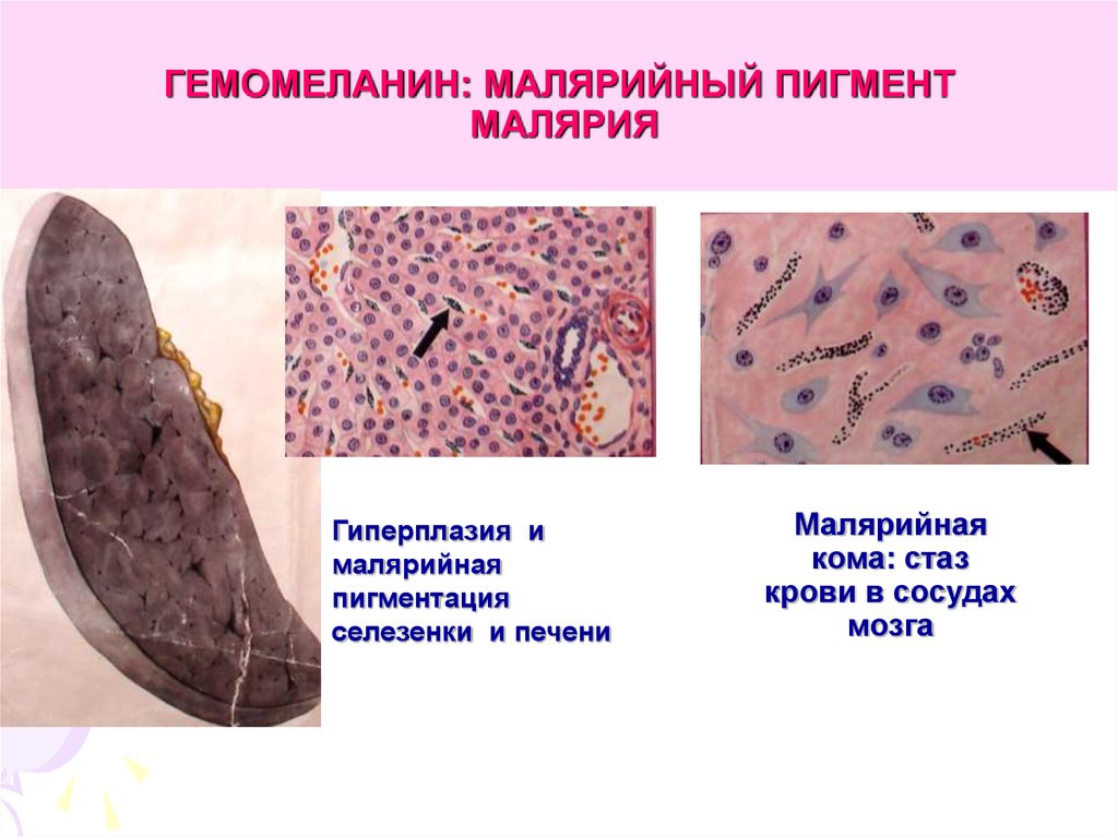 Микро изменение. Малярийный пигмент селезенки. Малярия патоморфология. Малярийный пигмент плазмодиев. Малярийный пигмент макропрепарат.