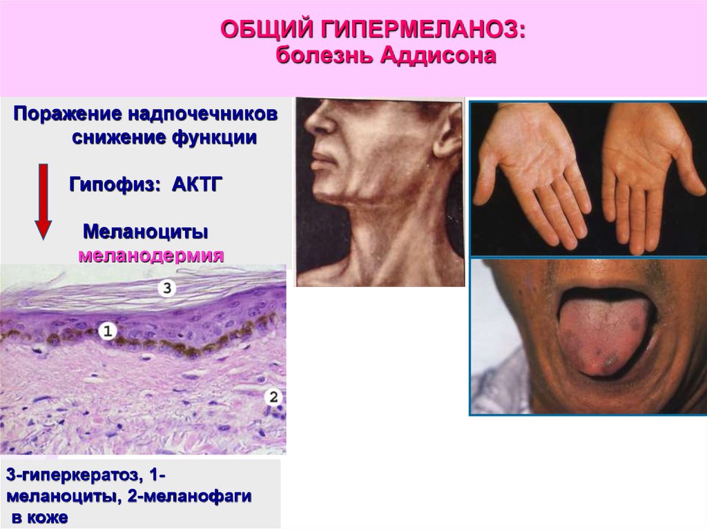 Болезнь аддисона презентация