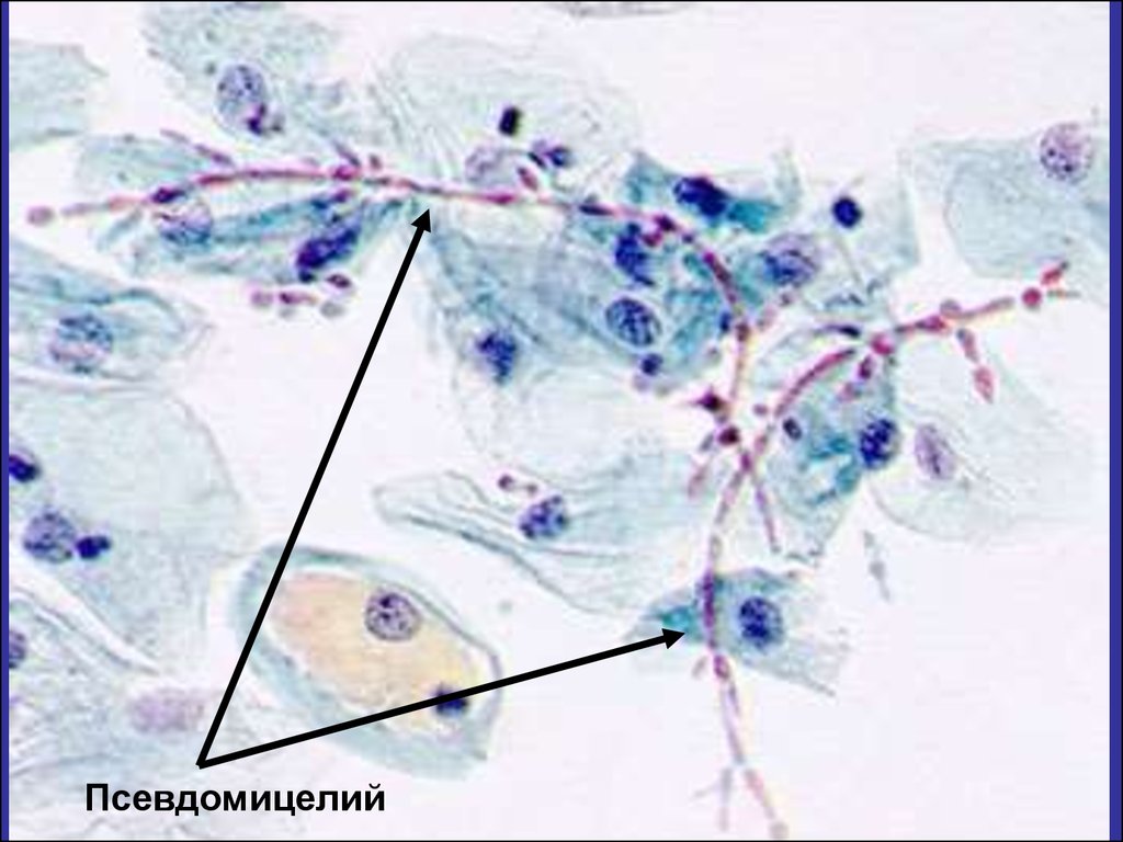 Псевдомицелий в мазке. Мазок кандида псевдомицелий. Бластоспоры и псевдомицелий. Мицелий и псевдомицелий в мазке.