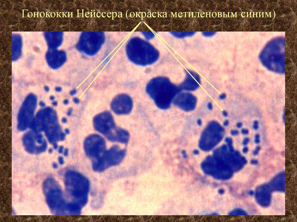 Chlamydia trachomatis neisseria gonorrhoeae. Гонорея микроскопия мазка. Трихомонады цитология. Кокки диплококки внеклеточные. Гонококки метиленовым синим микроскопия.