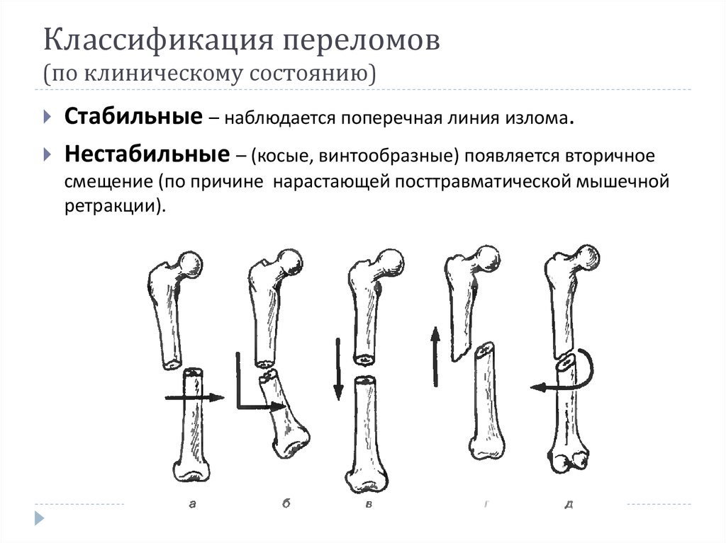 Смещение отломков кости