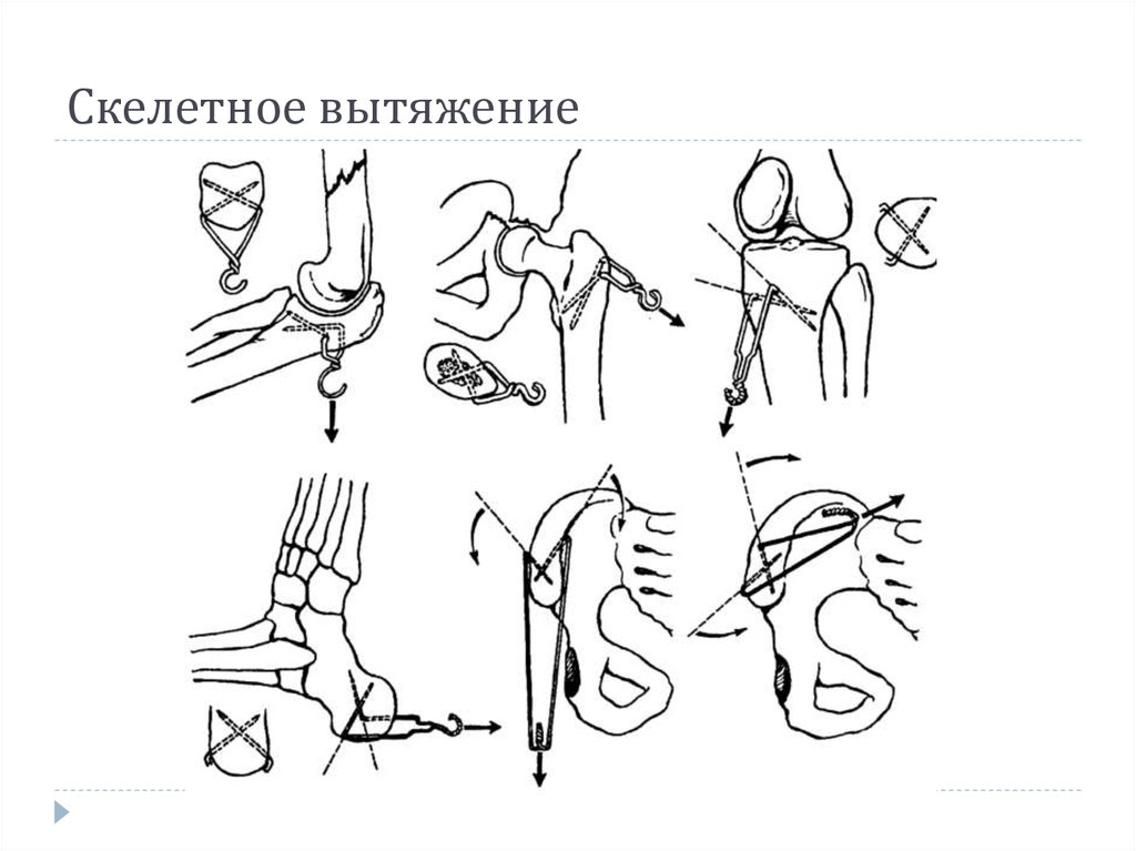 Скелетное вытяжение. Скелетное вытяжение схема. Скелетное вытяжение техника выполнения. Схема скелетного вытяжения при диафизарных переломах костей голени.