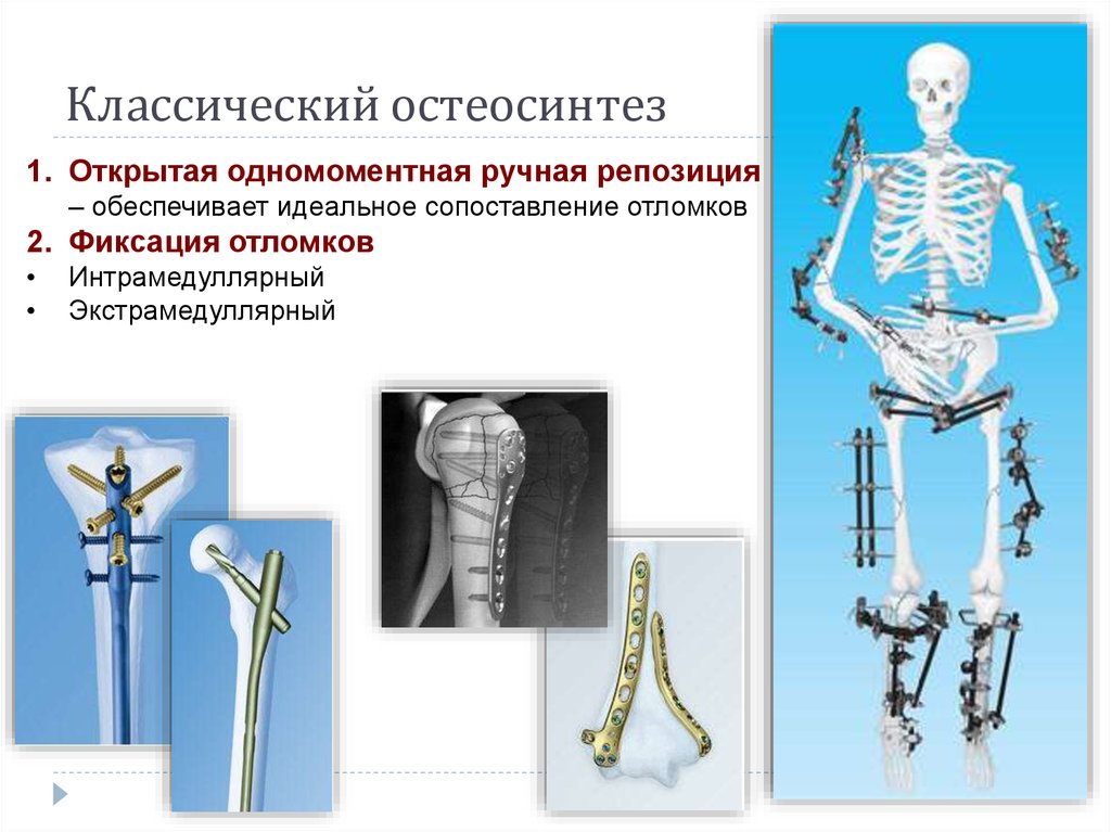 Открытая репозиция костей