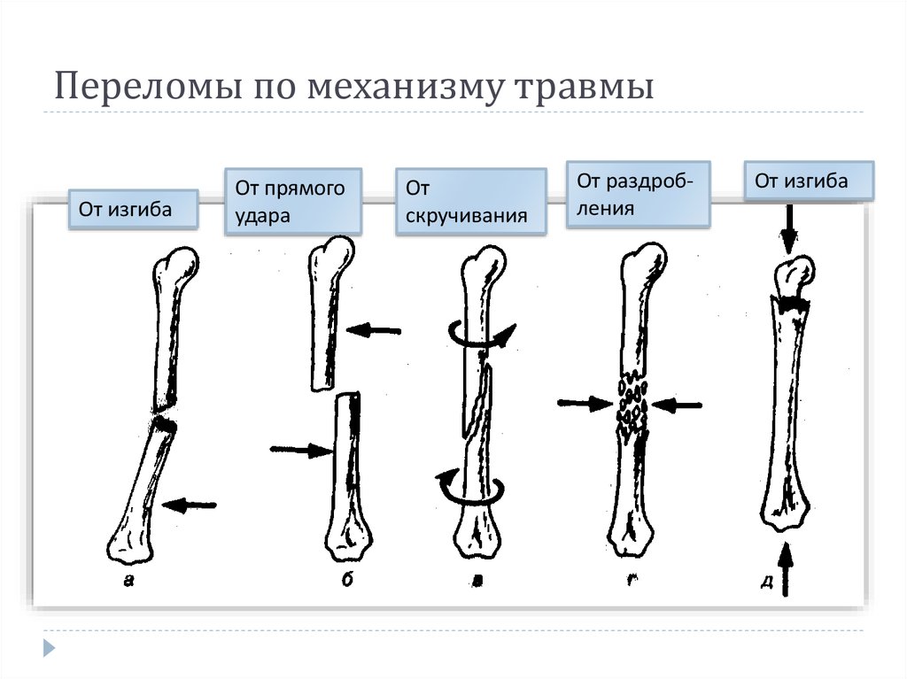 Удара предметом. Механизмы переломов трубчатых костей. Поперечный перелом трубчатой кости. Механизм образования переломов. Переломы костей по механизму.