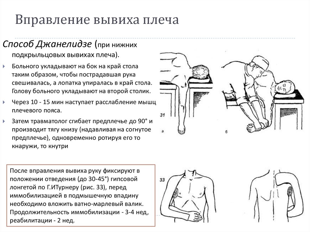 Иммобилизация лонгетой. Вправление плеча по методу Джанелидзе. Метод Джанелидзе вправление вывиха. Вправление вывиха плеча методом Джанелидзе. Методика вправления вывиха плеча.