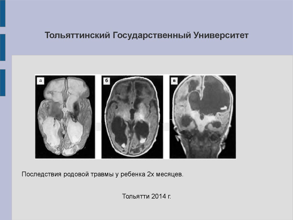 Последствия травм мкб 10. Периоды поражения ЦНС при родовой травме. Родовая травма последствия. Родовой травматизм плода.