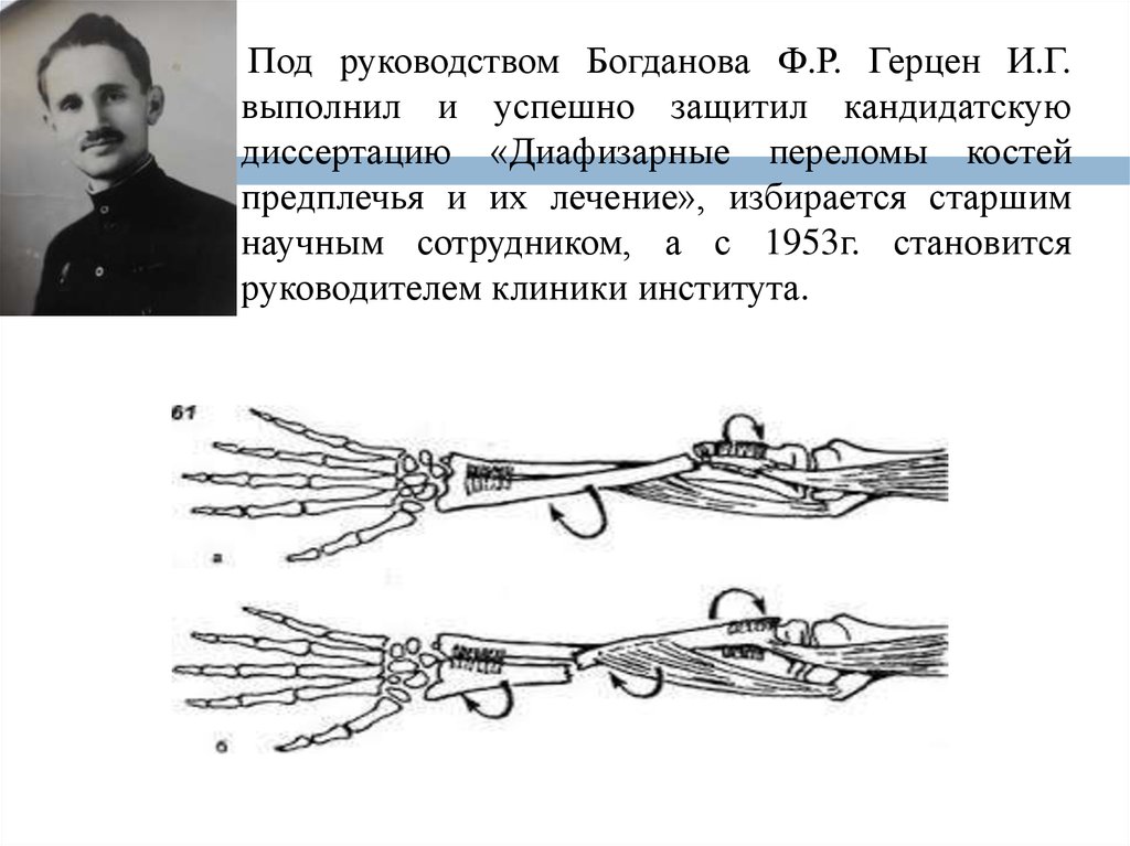 Диафизарные переломы предплечья. Богданов Федор Родионович. Богданов мануал. ● операция по Богданову ф. р..