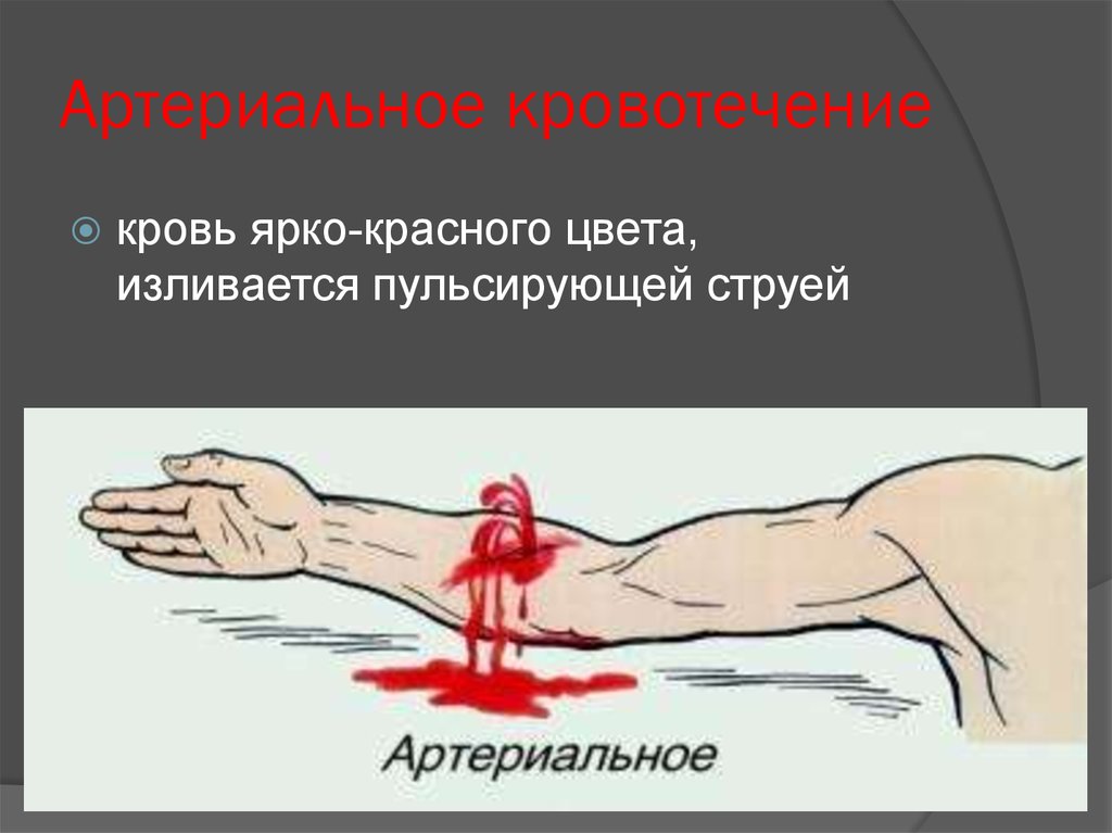 Артериальное кровотечение