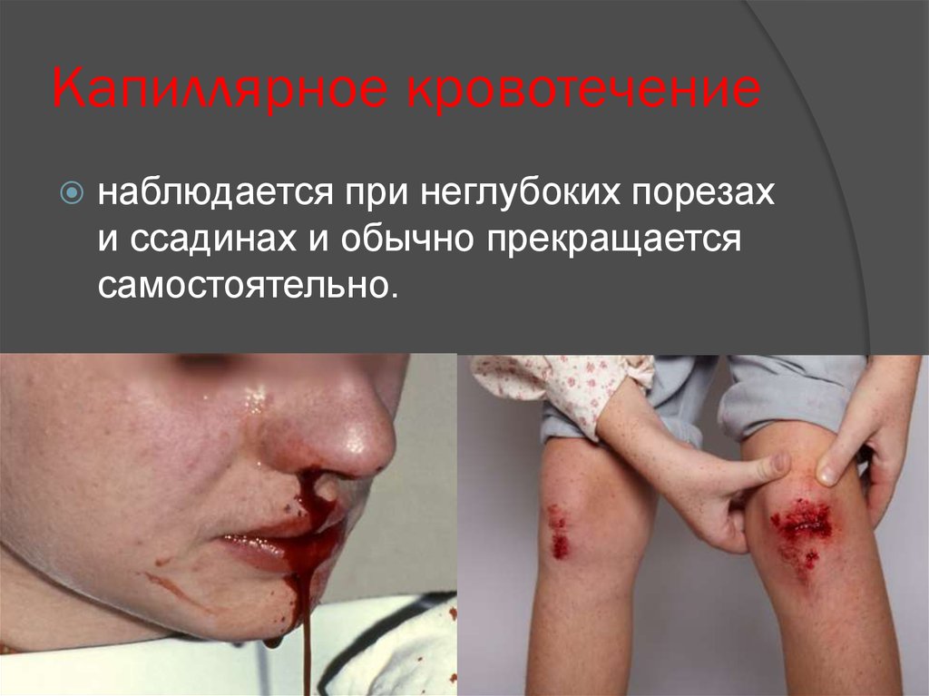 Капиллярное кровотечение