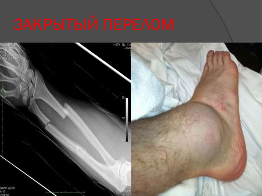 ЗАКРЫТЫЙ ПЕРЕЛОМ